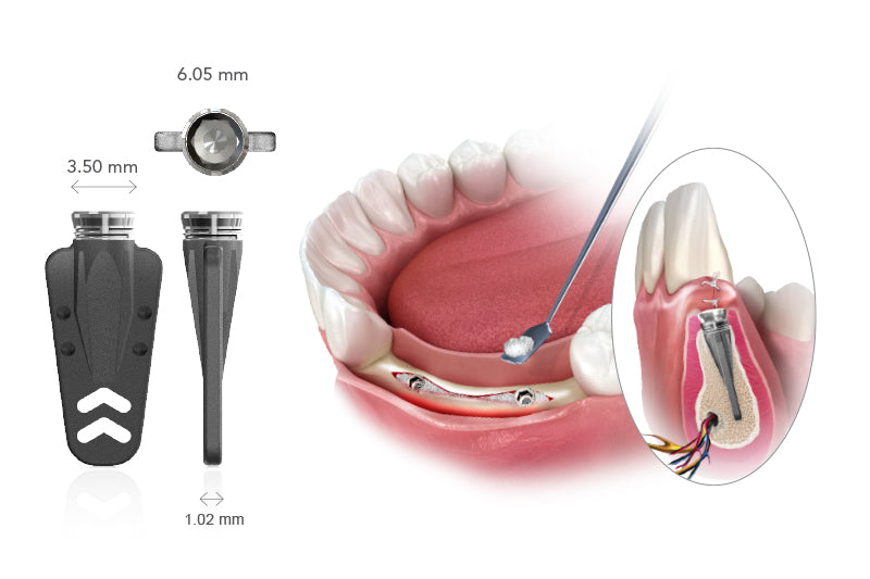 Startanius™ Narrow  Ridge Implants